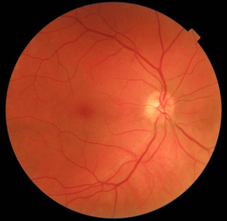 Óptica para hacer retinografías