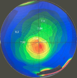 Pruebas diagnóstico queratocono